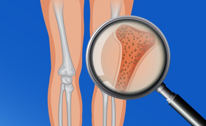 Hoy es el Día Internacional de la Osteoporosis