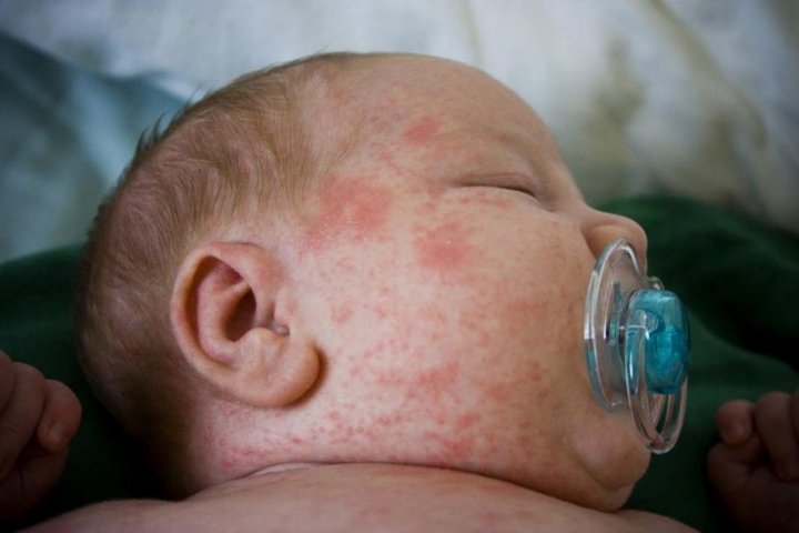 Alergia a la prote&iacute;na de la leche de vaca: por qu&eacute; ocurre y c&oacute;mo afecta a los beb&eacute;s